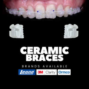 Ceramic Braces in Kochi 2026: Get a Perfect Smile Discreetly at Lavia Dental Care