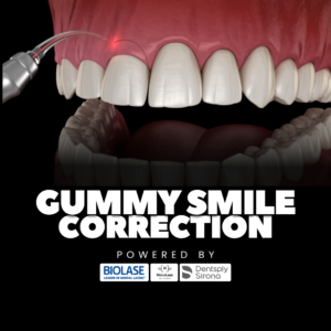 Say Goodbye to Your Gummy Smile: The Ultimate Guide to Smile Correction in Kochi