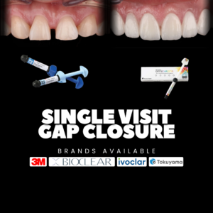 Teeth Gap Correction in Kochi: Costs, Treatments, and Choosing the Right Smile Fix