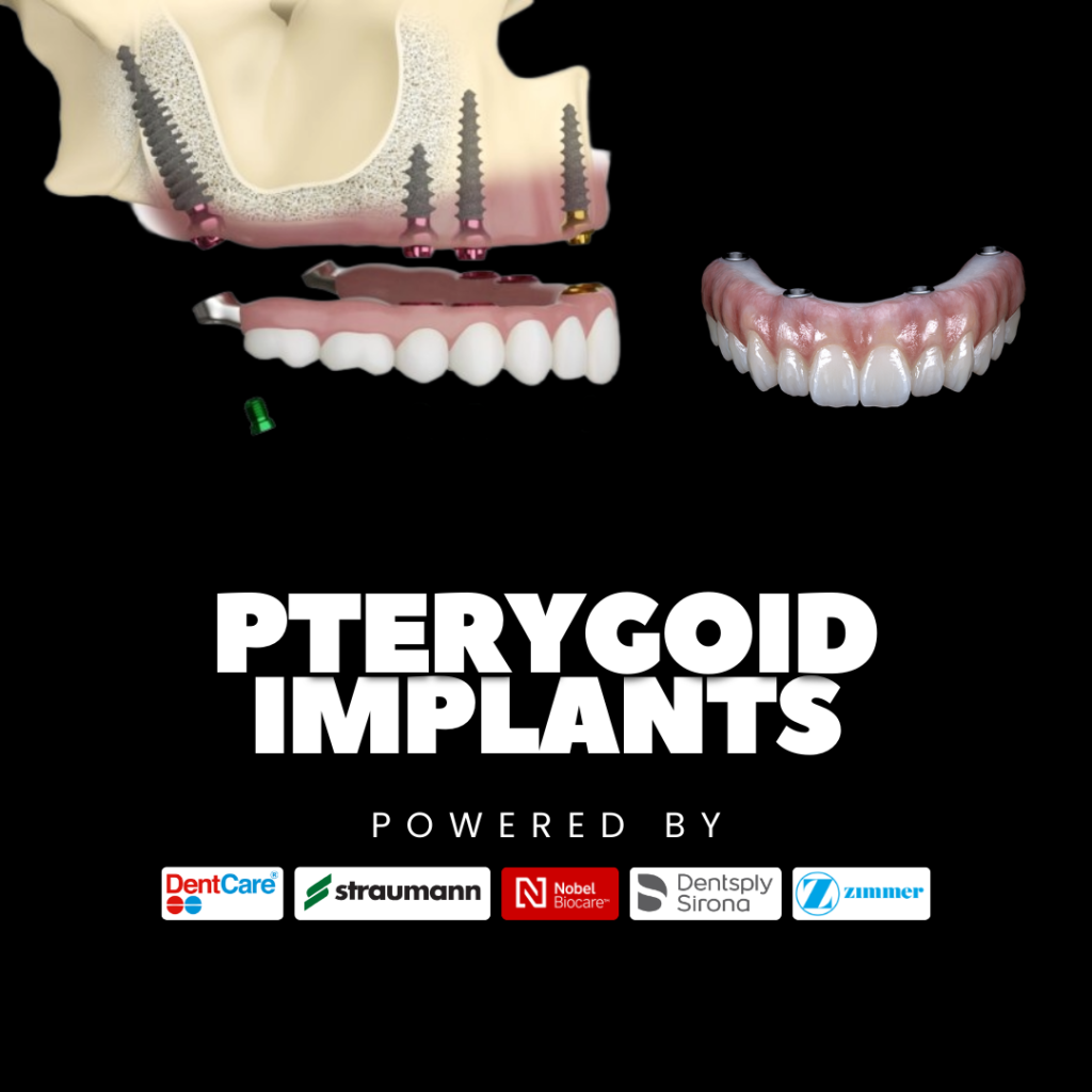 The Ultimate Guide to Dental Implants in Kochi (2026): Costs, Procedures, and Why Lavia Dental Care Leads the Way